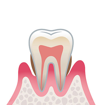 歯周病（中度）