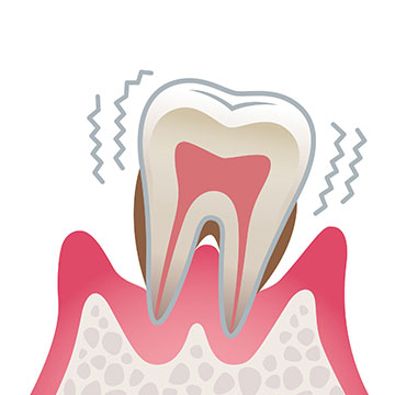 歯周病（重度）